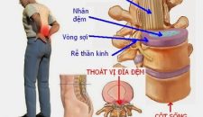 Quá trình tìm cách chữa trị bệnh thoát vị đĩa đệm