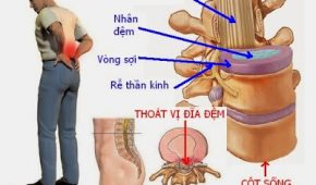 Quá trình tìm cách chữa trị bệnh thoát vị đĩa đệm